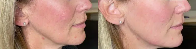 Dermal Fillers before and after photo by Monroe MedSpa in Rochester, NY Dermal Fillers before and after photo by Monroe MedSpa in Rochester, NY