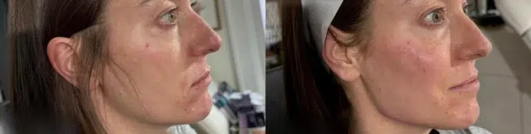 Dermal Fillers before and after photo by Monroe MedSpa in Rochester, NY Dermal Fillers before and after photo by Monroe MedSpa in Rochester, NY