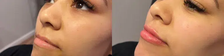 Dermal Fillers before and after photo by Monroe MedSpa in Rochester, NY Dermal Fillers before and after photo by Monroe MedSpa in Rochester, NY