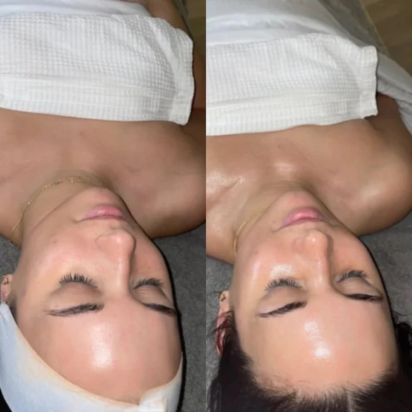 jetpeel before and after photo by monroe medspa