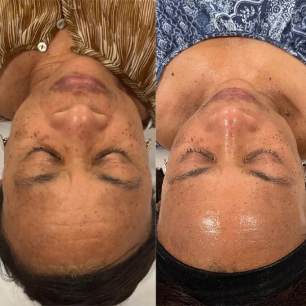 chemical peel before and after photo by monroe medspa