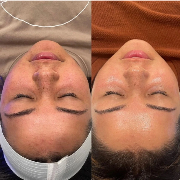 cynosure laser before and after photo by monroe medspa