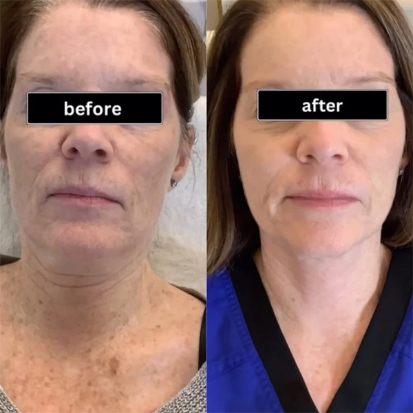 moxi before and after photo by monroe medspa