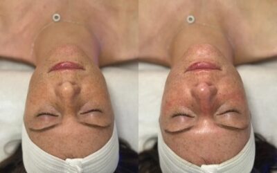 hydrafacial before and after photo by monroe medspa in rochester ny x