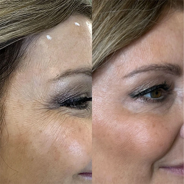 injectables before and after photo by monroe medspa