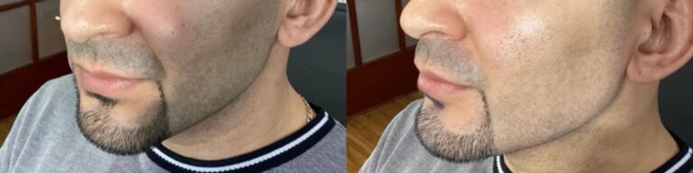 dermal fillers before and after photo by monroe medspa in rochester ny x dermal fillers before and after photo by monroe medspa in rochester ny x