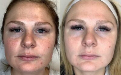 microneedling before and after photo by monroe medspa in rochester ny x