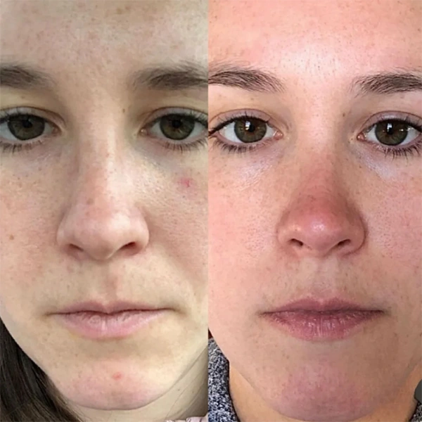 skin before and after photo by monroe medspa