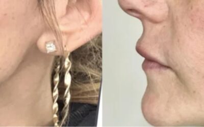 microneedling before and after photo by monroe medspa in rochester ny x