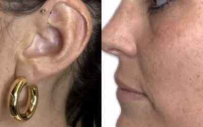 microneedling before and after photo by monroe medspa in rochester ny x