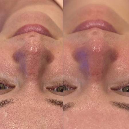 hydrafacial before and after photo by monroe medspa in rochester ny