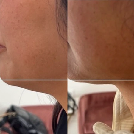 kybella before and after photo by monroe medspa in rochester ny