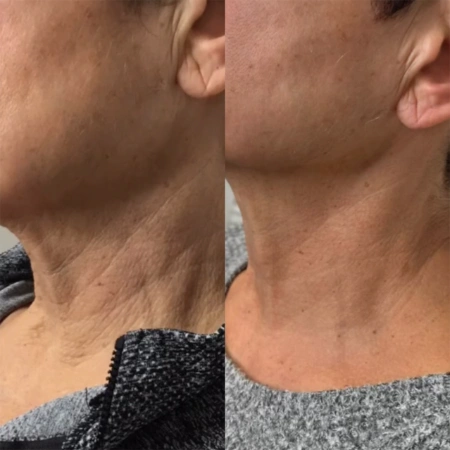 radiesse before and after photo by monroe medspa in rochester ny